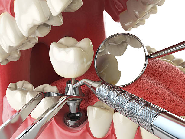 Best Broken or Cracked Tooth Emergency Dentist in Noank, CT